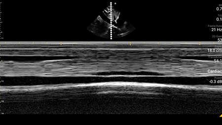 Inferior vena cava with M-Mode trace shown using S4-1 transducer.