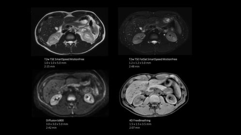 Full free breathing pancreas exam on Ambition 1.5T