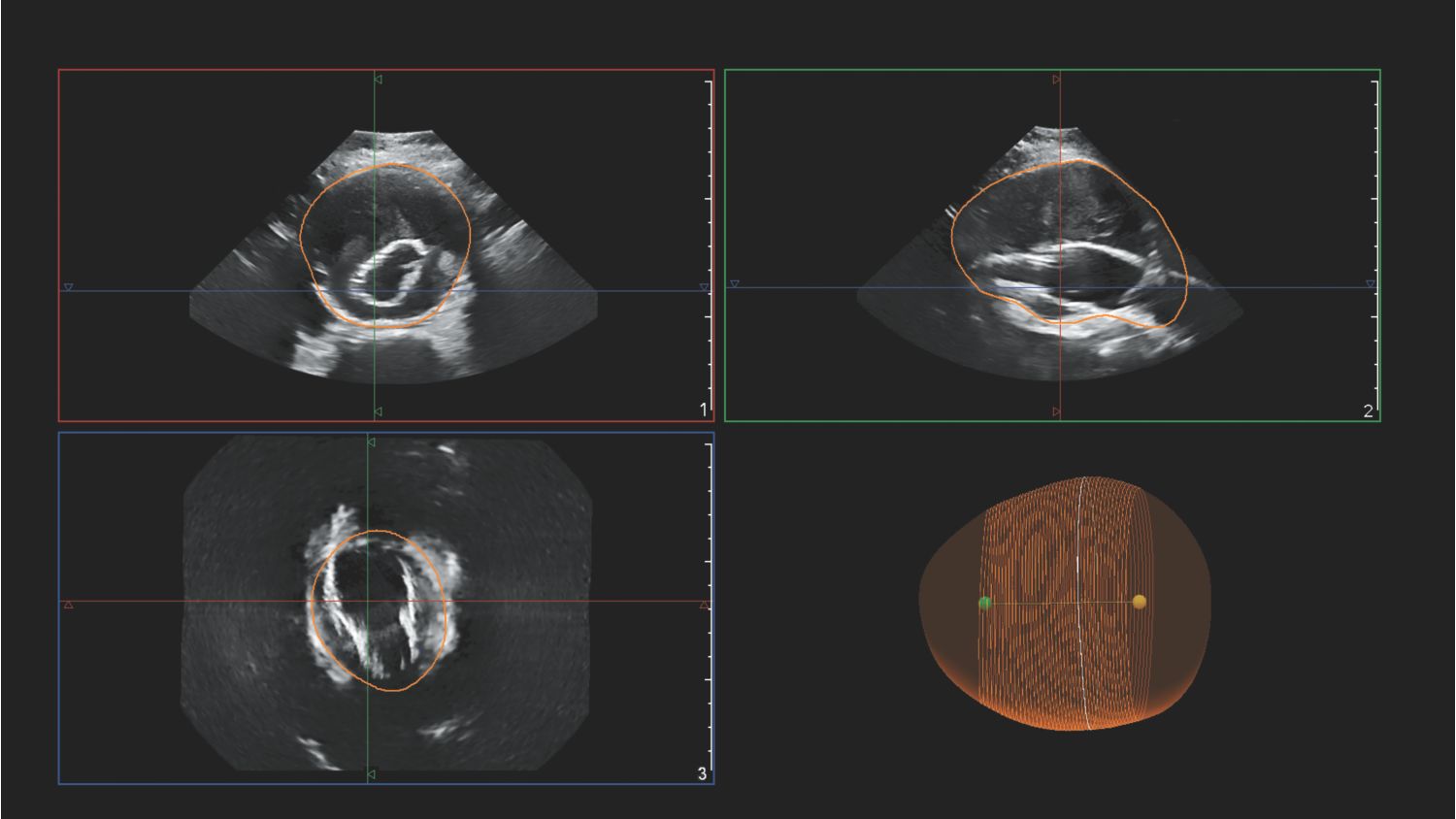 Clinical image of Philips AAA model scan
