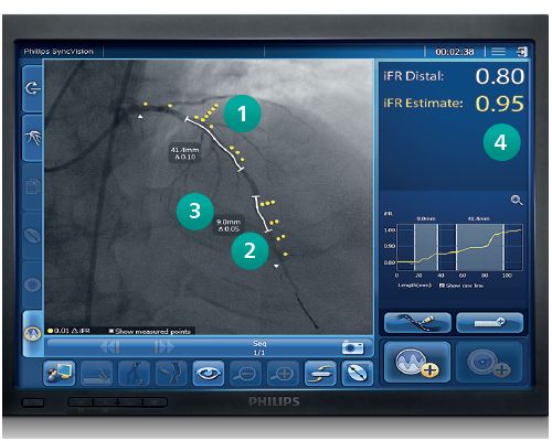 Advanced physiologic guidance with Philips iFR