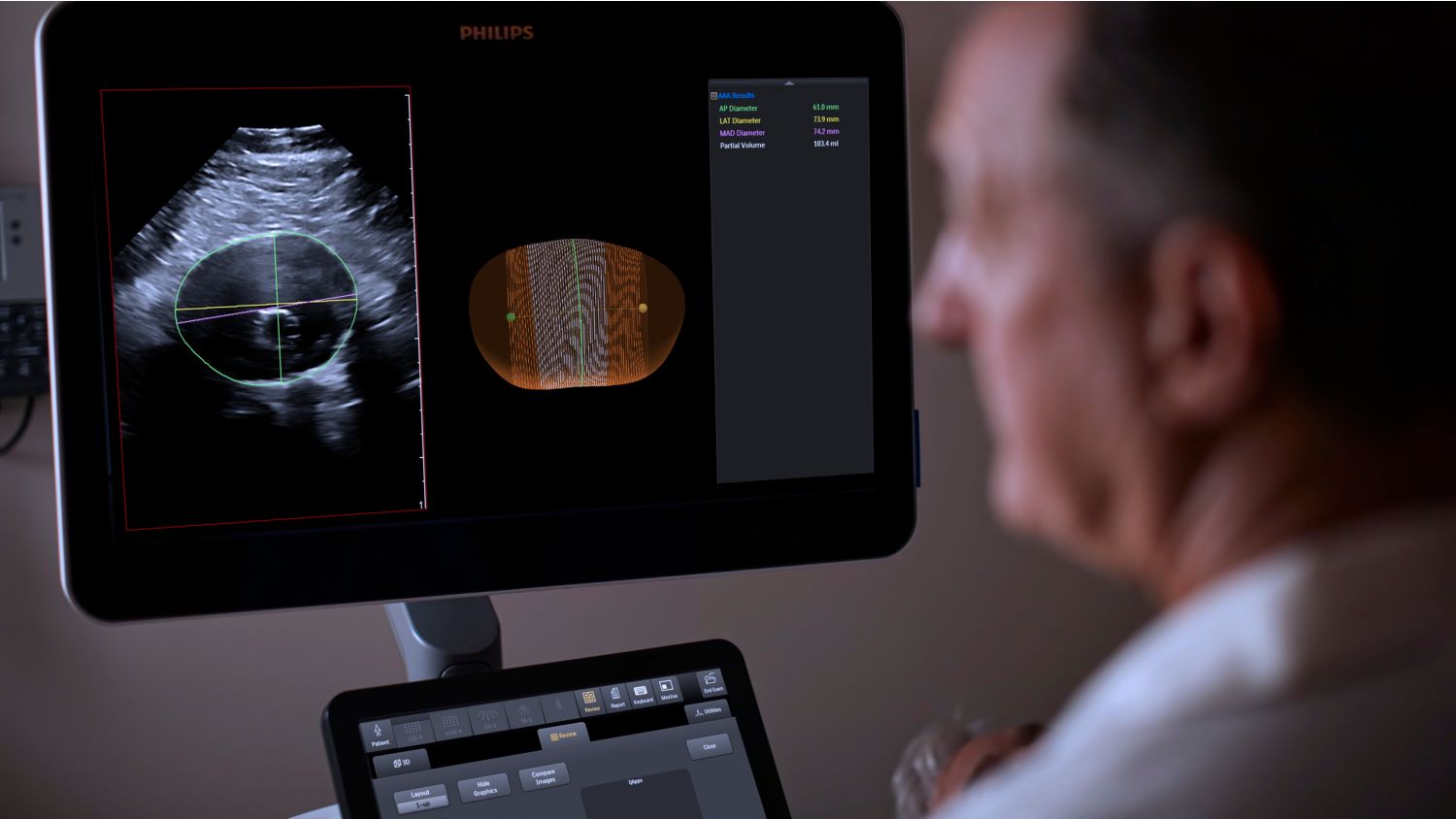 Product in use photo of EPIQ Elite AAA with X6-1 ultrasound, Abdominal Aortic Aneurysm