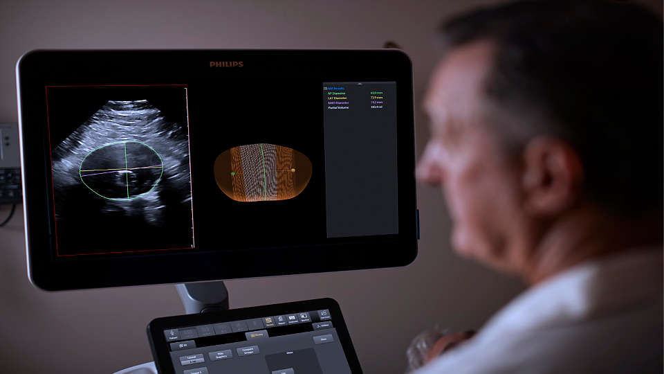 Product in use photo of EPIQ Elite AAA with X6-1 ultrasound, Abdominal Aortic Aneurysm