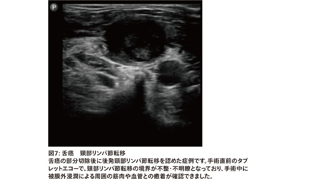 図7: 舌癌　頸部リンパ節転移