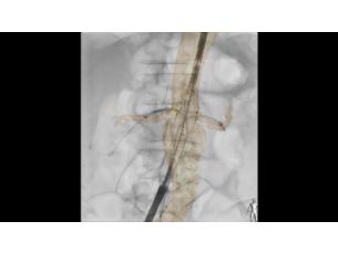 VesselNavigator Tecnologia de fusão de imagens 3D para procedimentos endovasculares