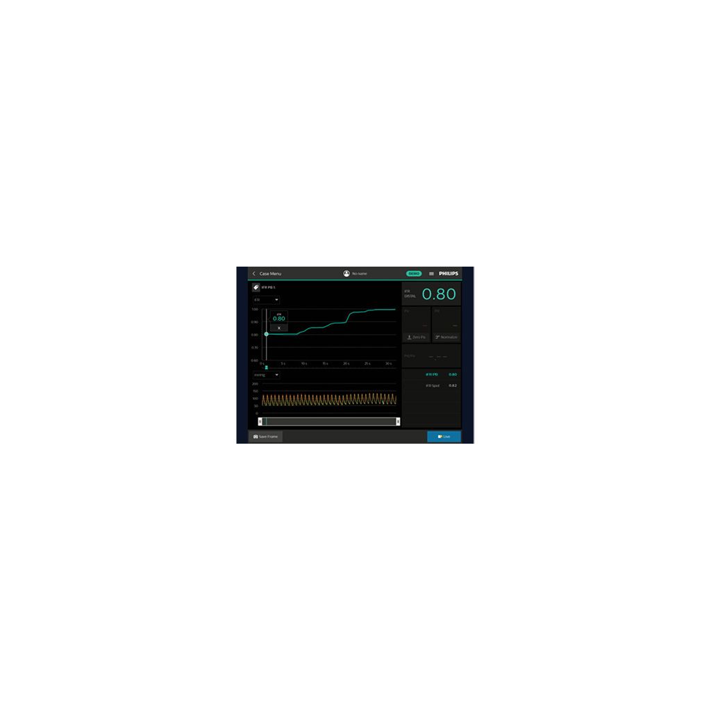 iFR Scout pullback