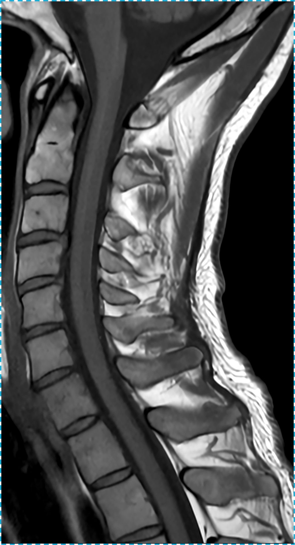 C Spine T1