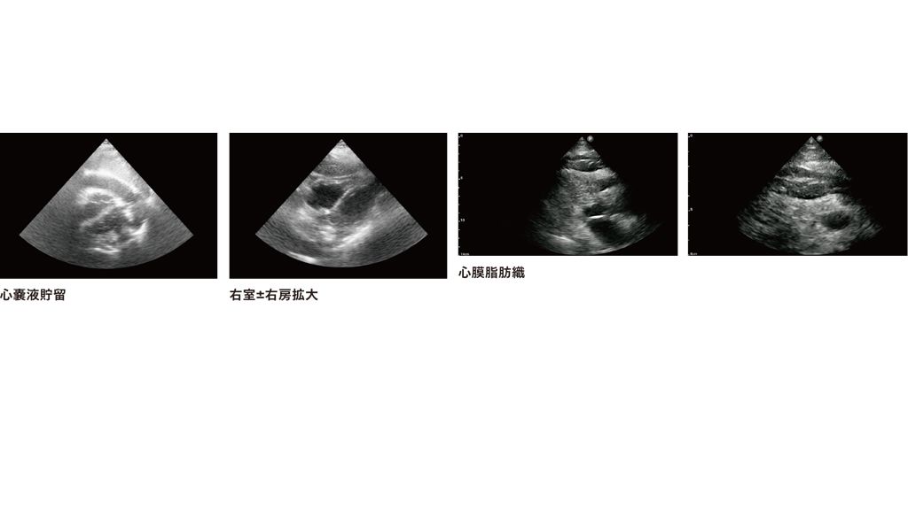 心嚢液貯留　　右室±右房拡大　　　心膜脂肪織