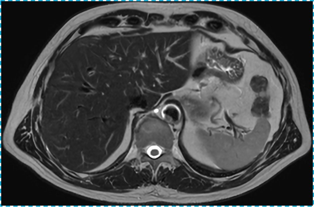 Liver T2 TSE