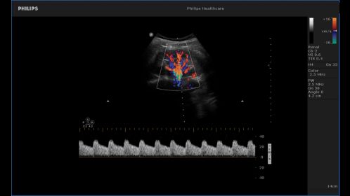 Renal doppler