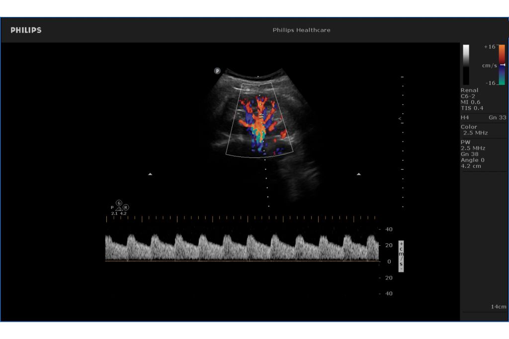 Renal doppler