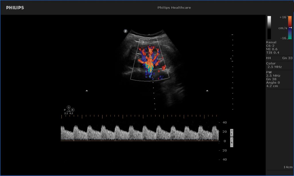 Renal doppler
