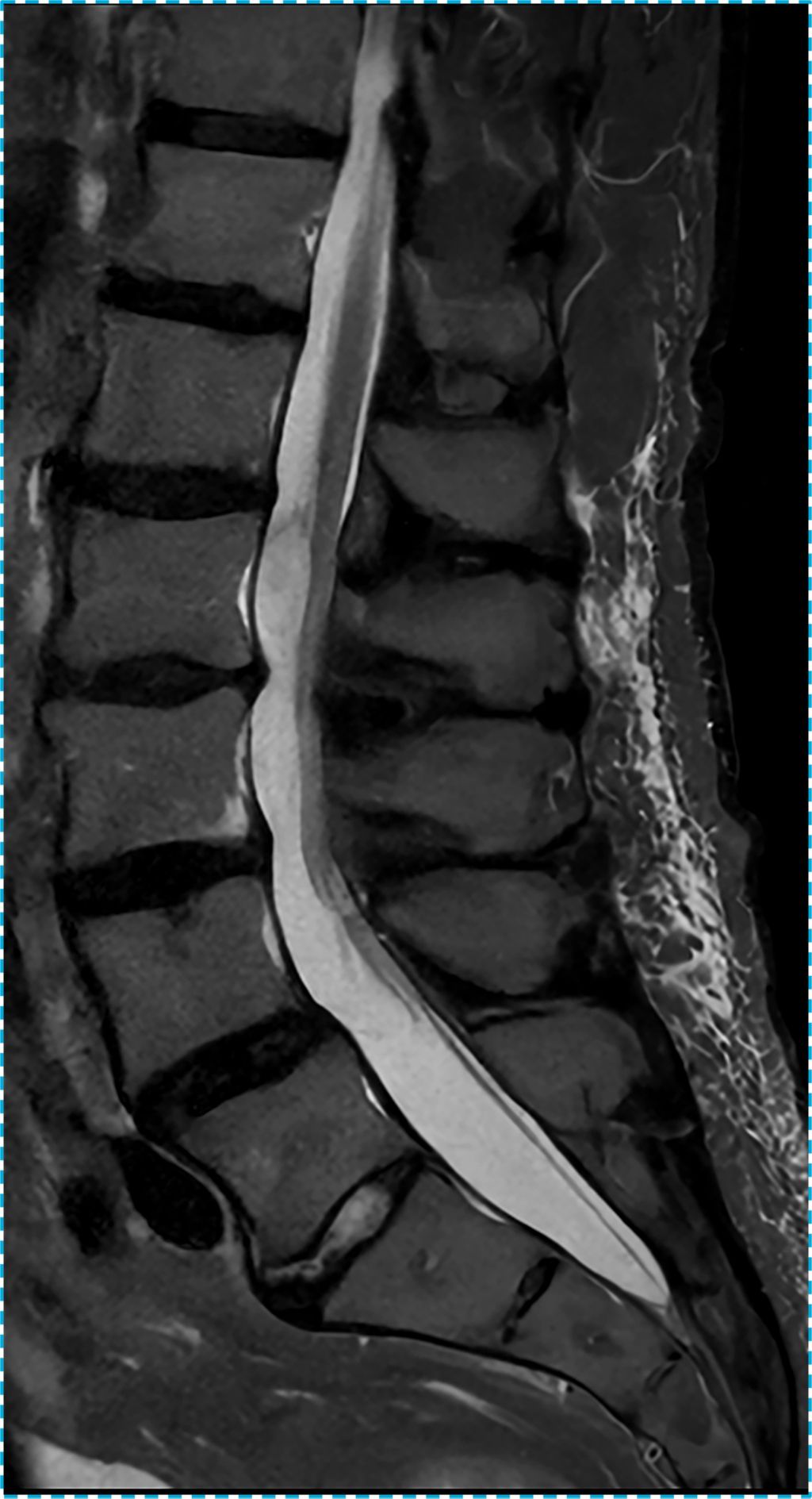 L Spine STIR