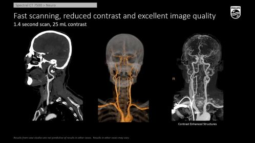 CT Spectral 7500 Neuro Head Neck Fast Scan and Low Contrast