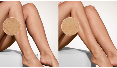 More than 80% hair reduction after just 2 sessions**