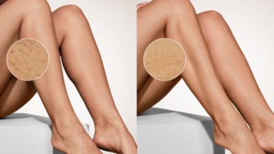 More than 80% hair reduction after just 2 sessions**