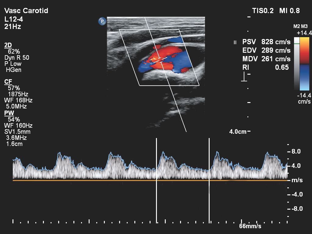 Affiniti 30 ultrasound clinical image vascular carotid