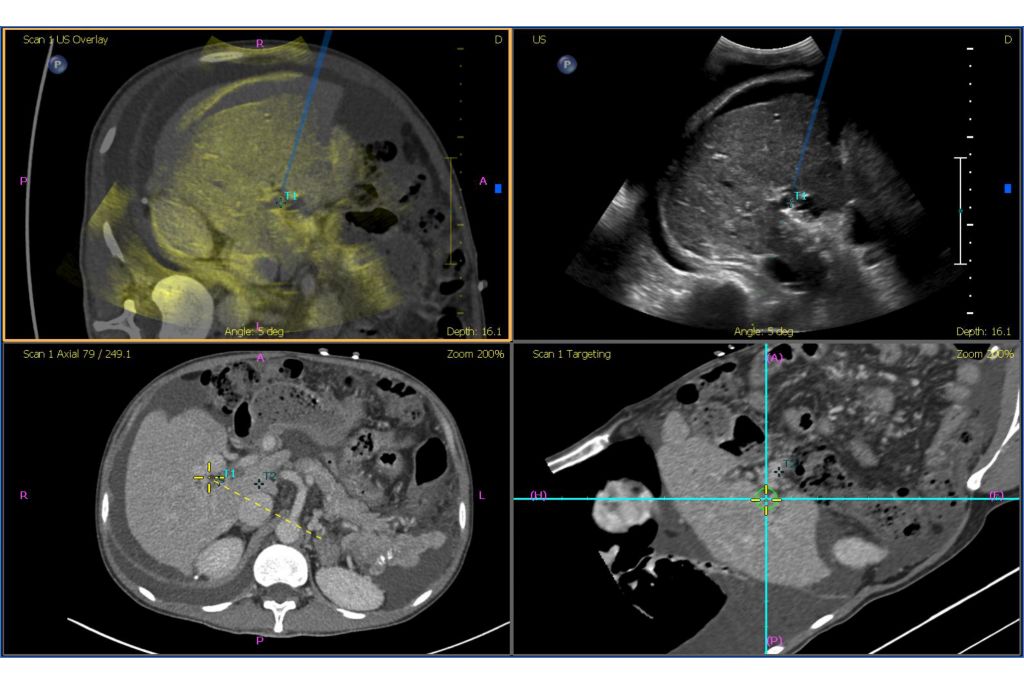 Fusion guidance with Coaxial Needle Tracker