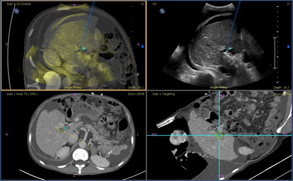 Fusion guidance with Coaxial Needle Tracker
