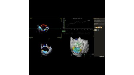 3D Auto Color Flow Quantification***