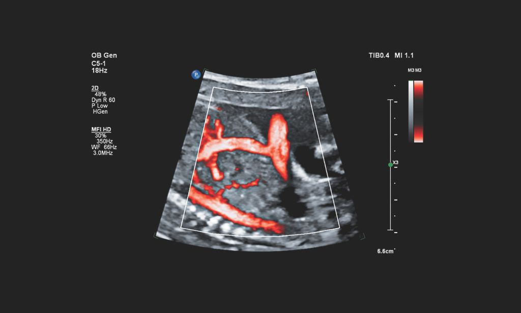 Fetal ductus venous with MFI HD