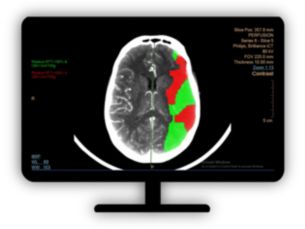 CT Brain Perfusion Determine areas of reduced cerebral blood flow compared to the contralateral hemisphere​