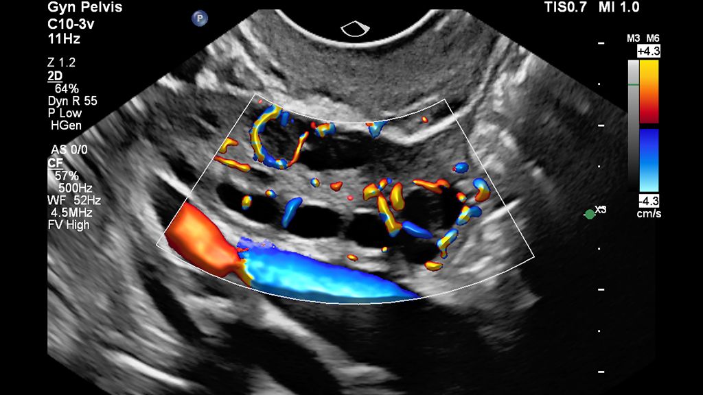Clinical Color Flow image of ovary scanned with Flow Viewer on EPIQ Elite