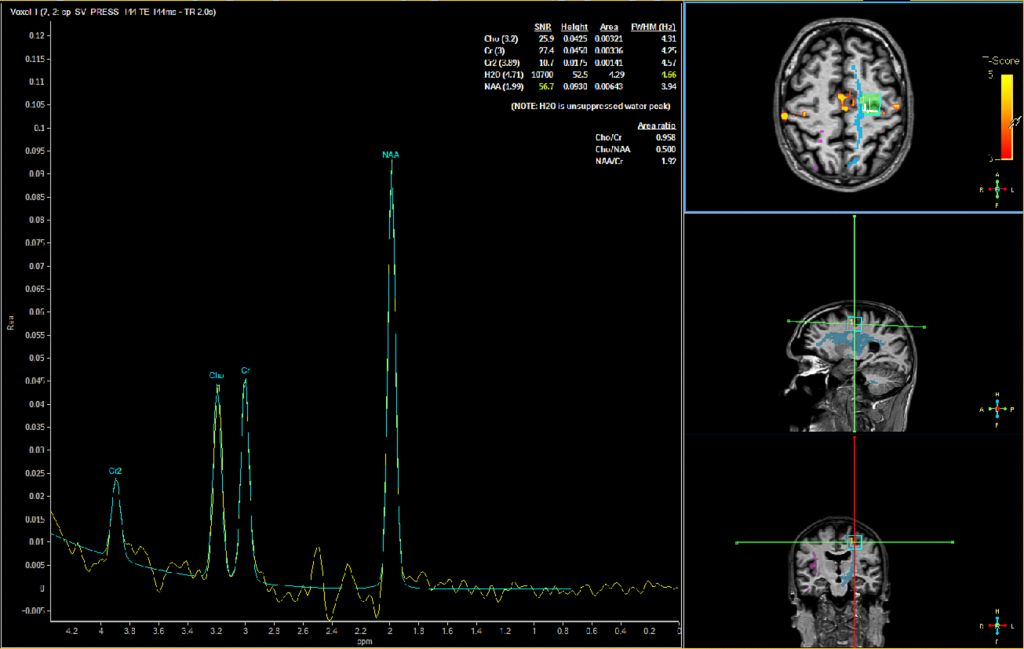 Spectroscopy Imaging fused with fMRI and DTI