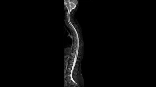 Sagittal T2w TSE mDIXON (Water only)- Total Spine