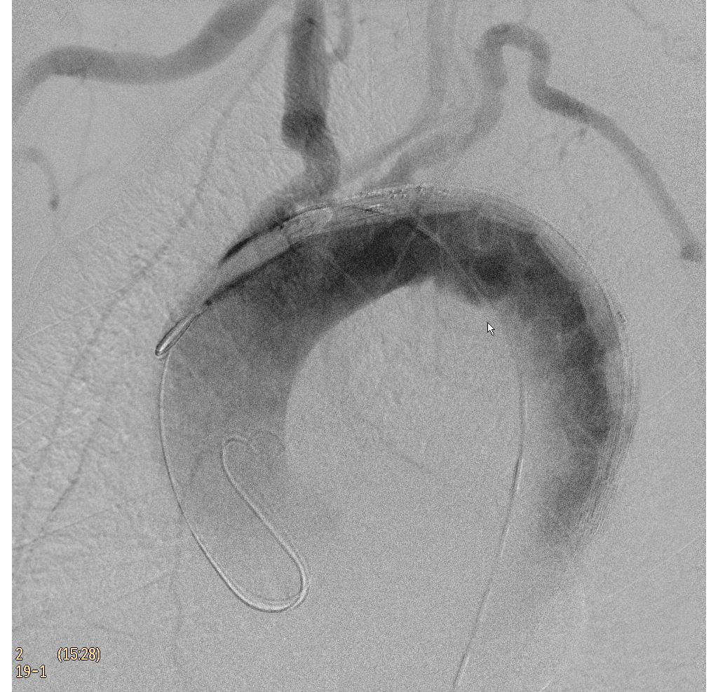 Clinical Image Philips Veradius Unity Mobile C-arm with Flat Detector