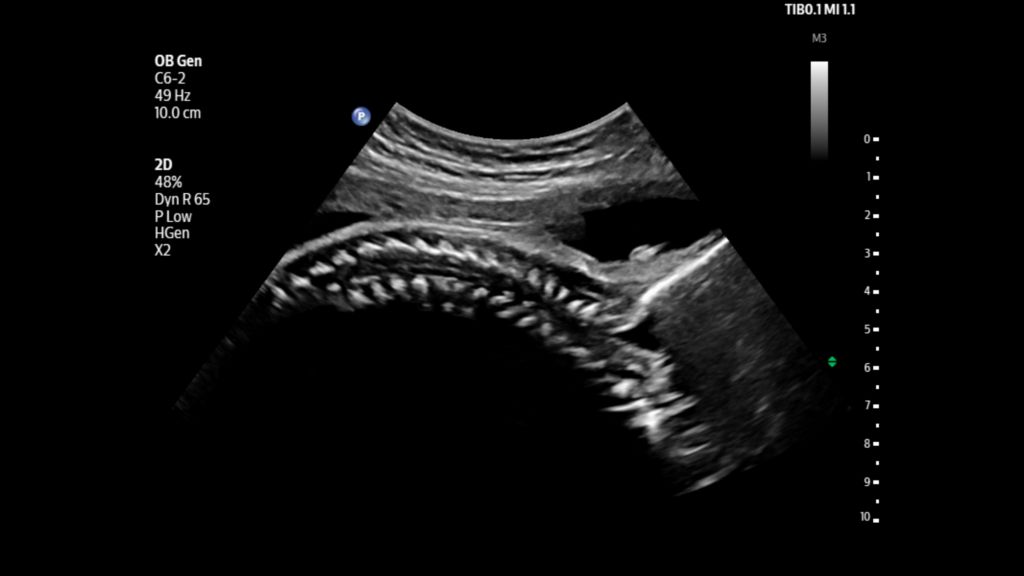 Fetal spine shown using C6-2 transducer on Flash 5100 POC.