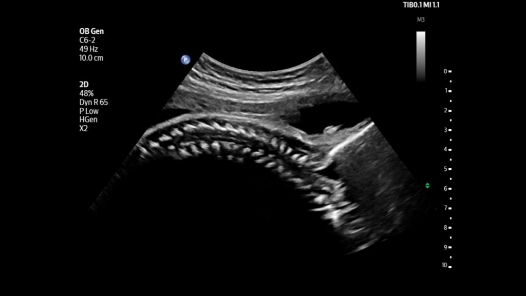 Fetal spine shown using C6-2 transducer.