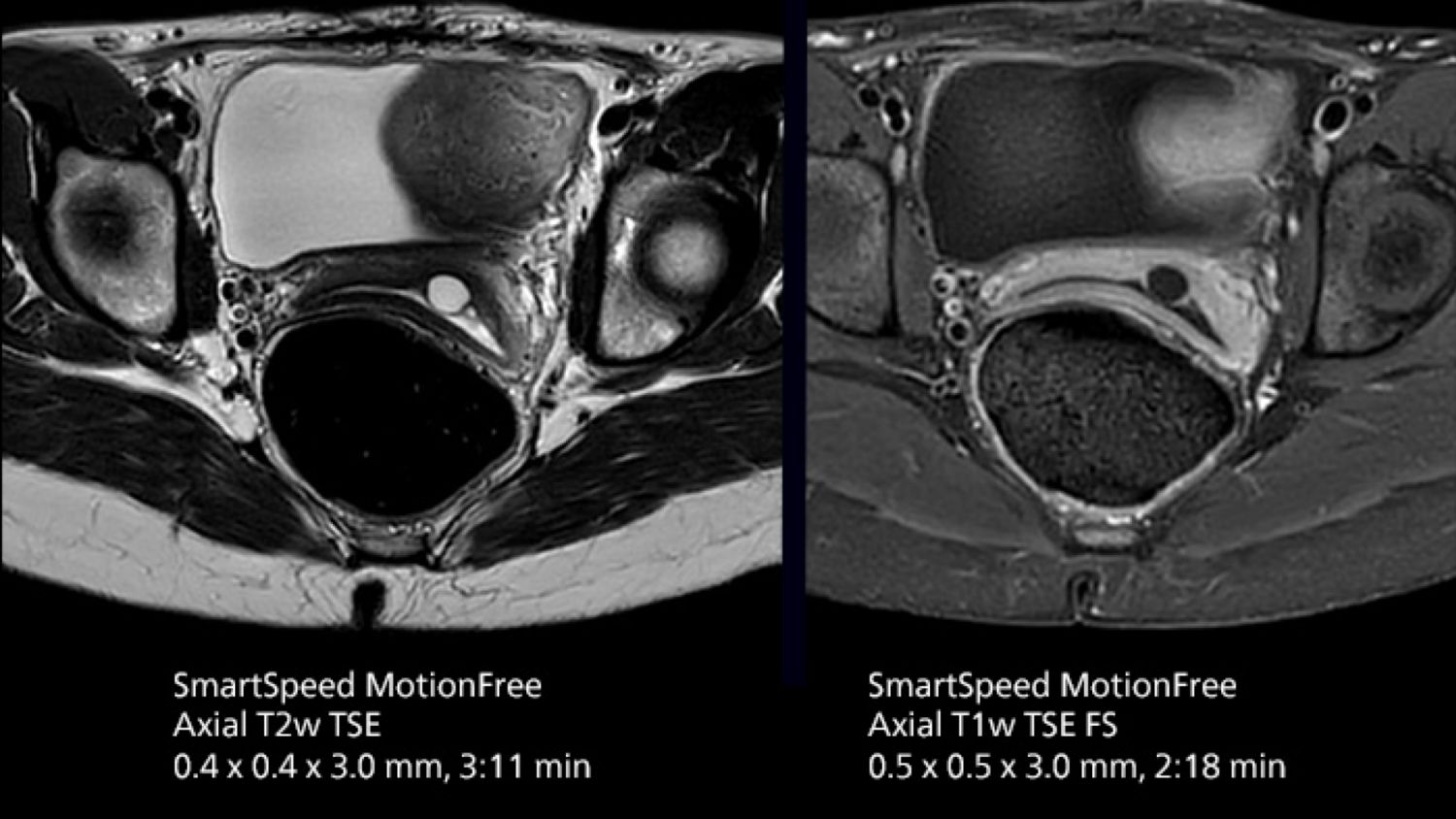 Motion robustness and high-resolution uterus protocol.