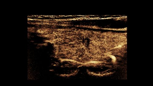 eL18-4 Thyroid CEUS