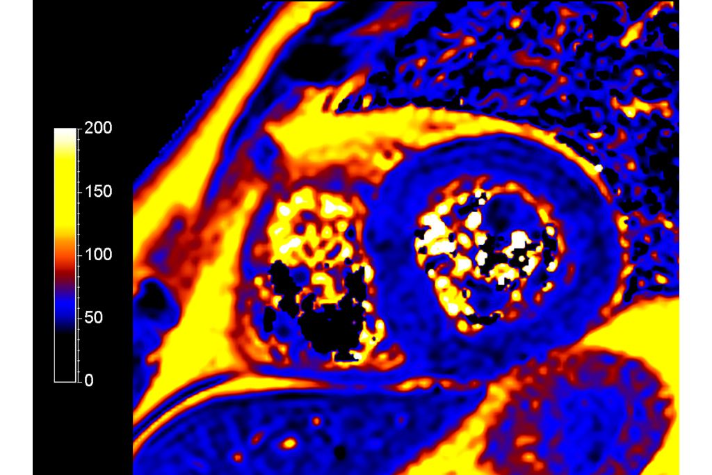CardiacQuant - T2 map