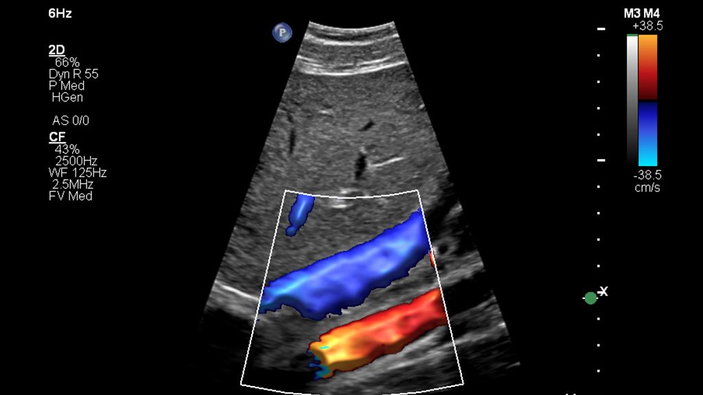 Clinical image using Affiniti and and C5-1 transducer showing abdomen vascular with IVC color 