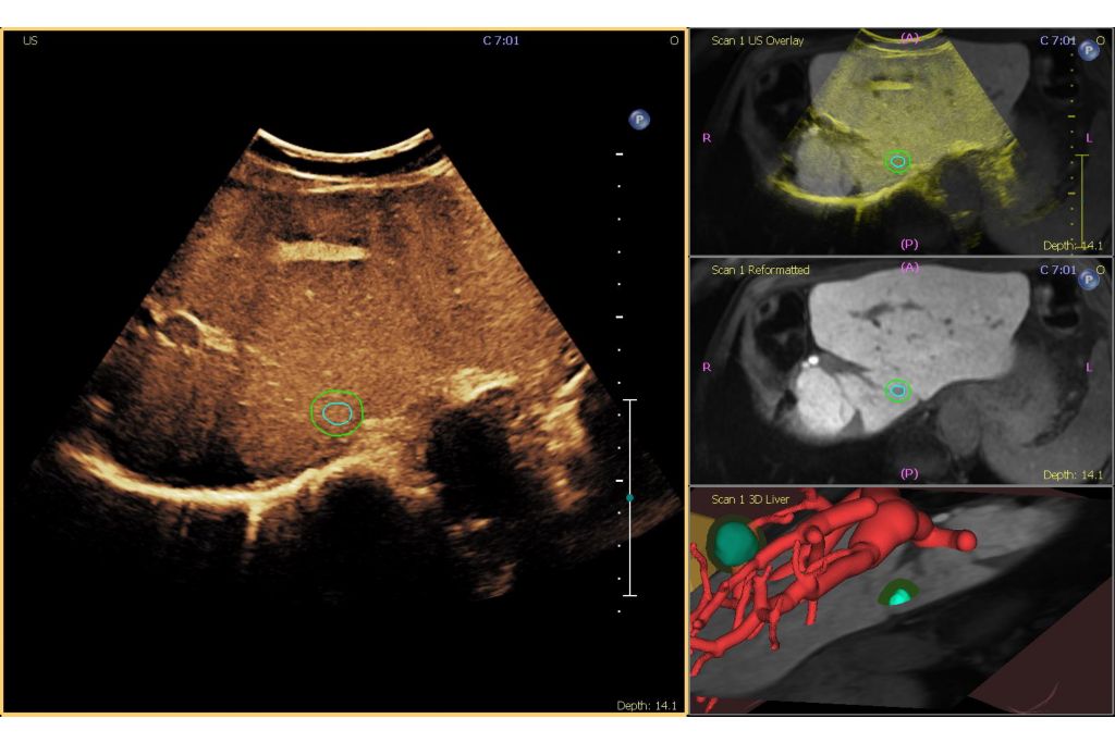 MR and CEUS Fusion using Tumor Contour