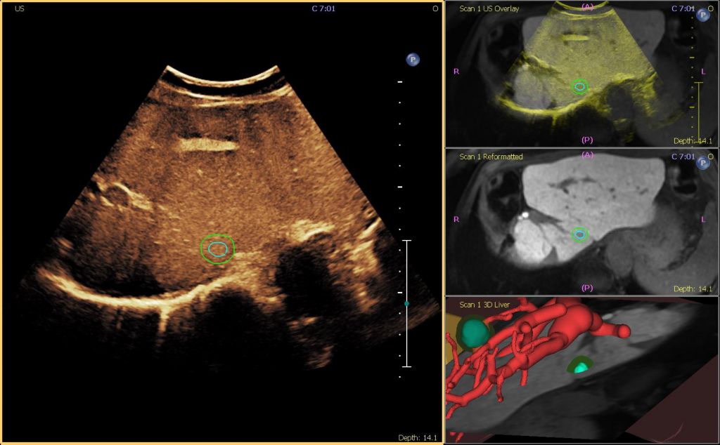 MR and CEUS Fusion using Tumor Contour