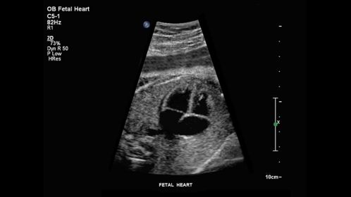 Fetal heart