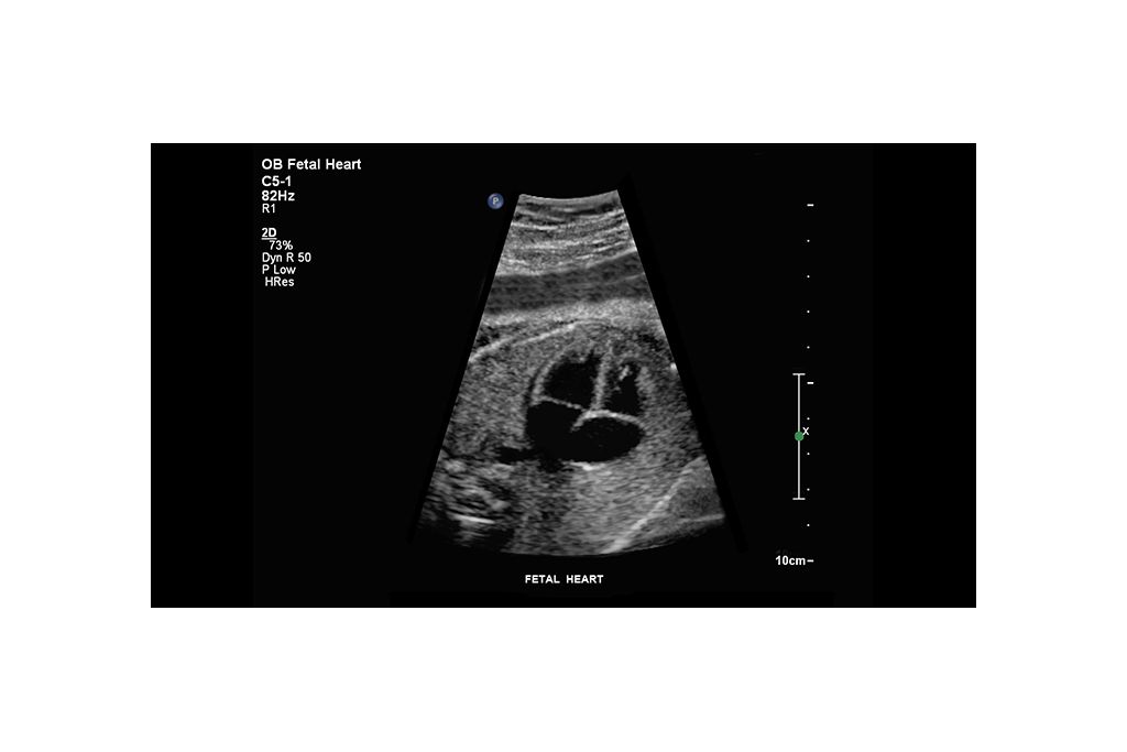 Fetal heart