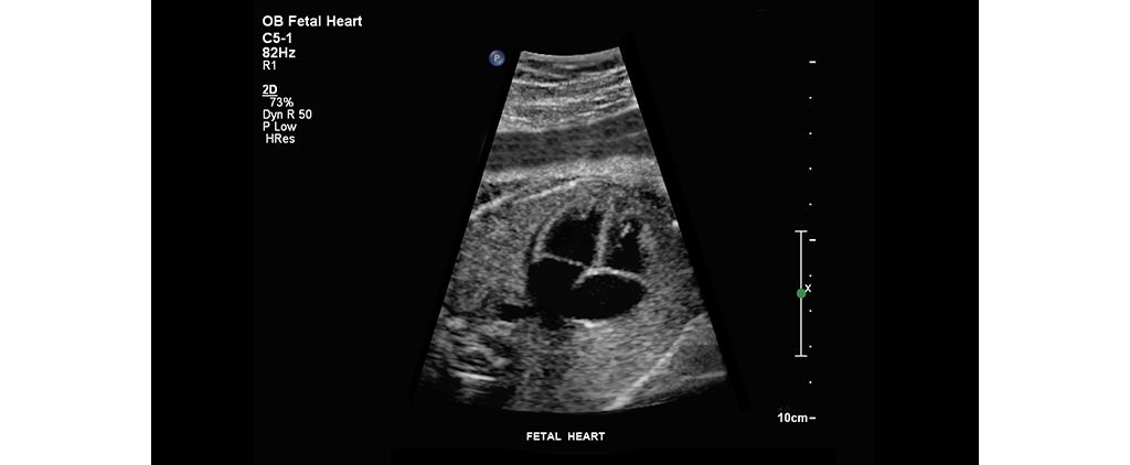 Fetal heart