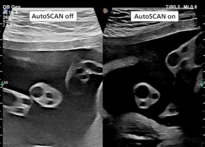 eL18-4 transducer image showing visual difference of scan with and without utilizing of autoSCAN