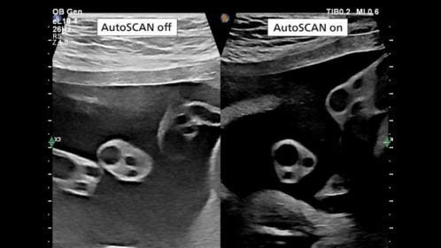 AutoSCAN on/off using eL18-4 transducer