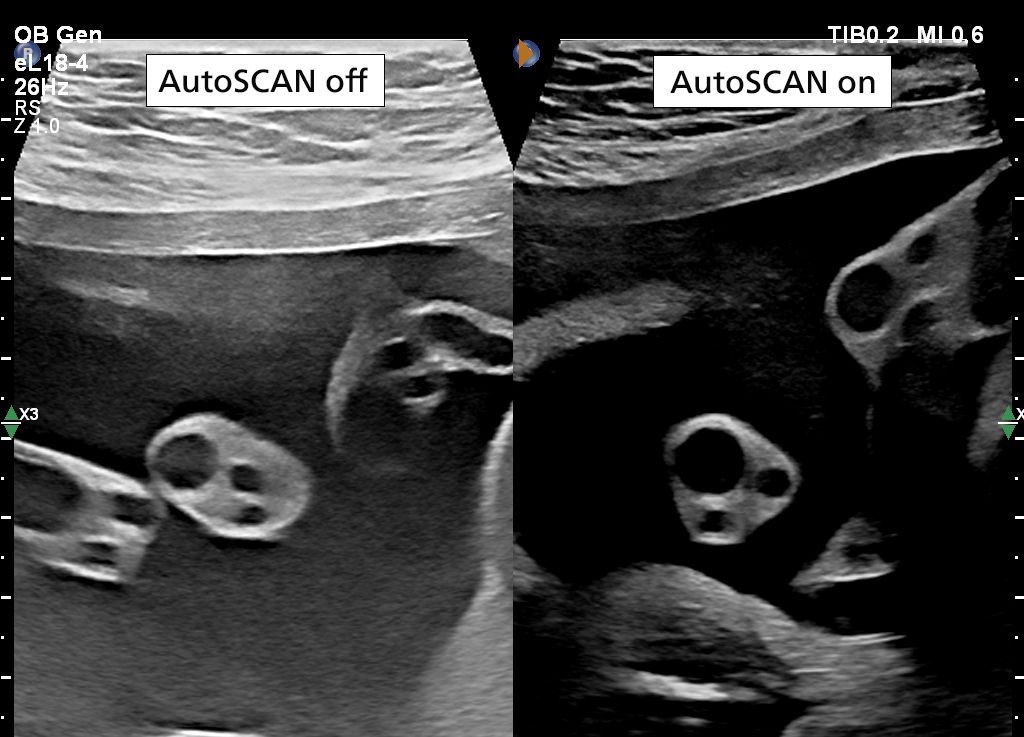 AutoSCAN on/off using eL18-4 transducer