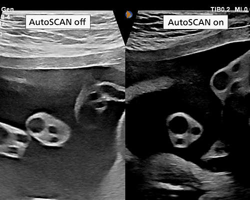 eL18-4 transducer image showing visual difference of scan with and without utilizing of autoSCAN