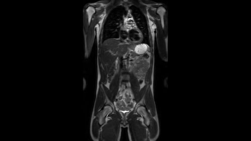 Coronal T2w TSE