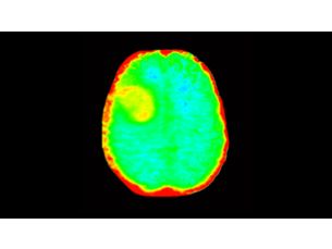 3D APT MR Clinical applications