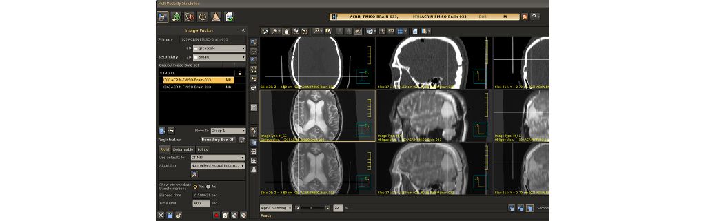 MR soft tissue characterization capability assists in target and critical organ contouring.