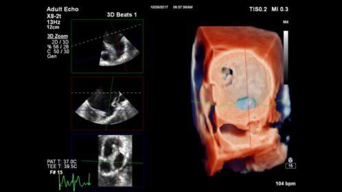 TrueVue of 3D Zoom rendering for LAA with MultiVue