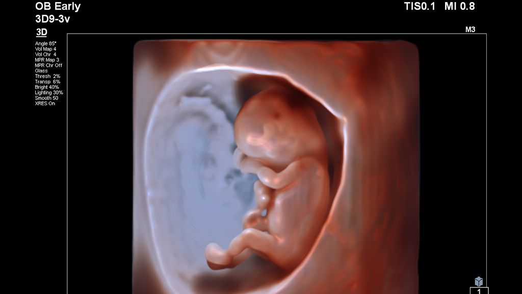 Eleven-week fetus image using GlassVue and 3D9-3V transducer