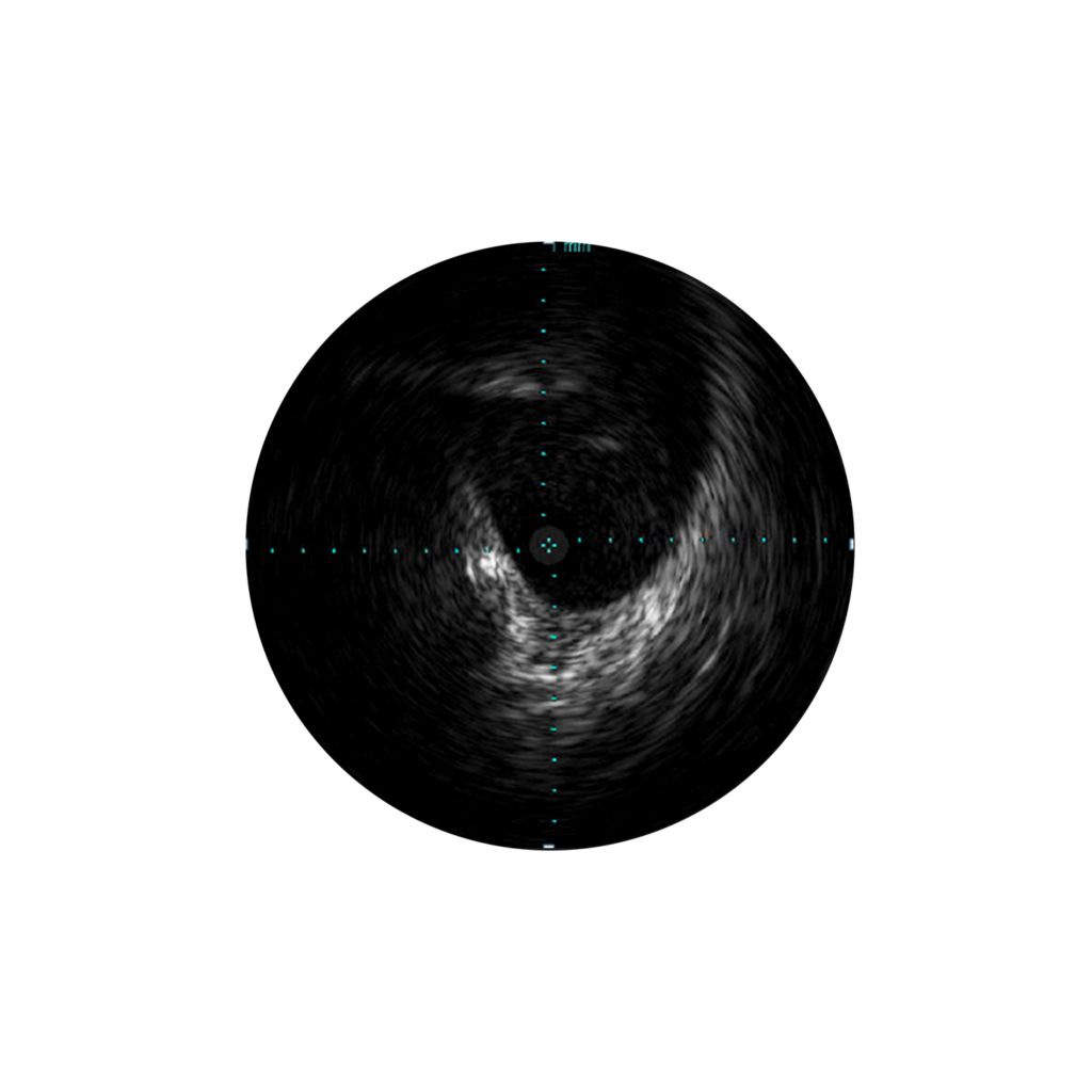 IVUS assesses disease